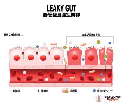 Leaky Gut Syndrome(LGS) 腸管壁浸漏症候群